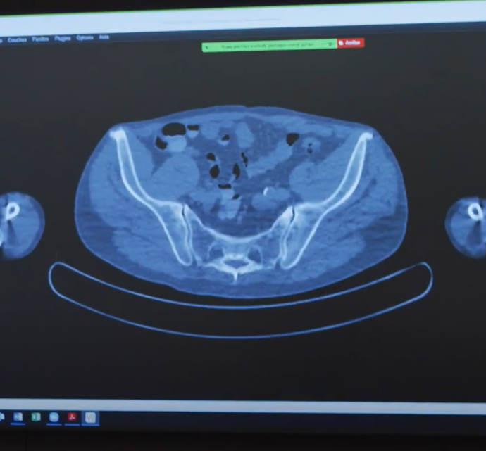 Radio : surveillance active lors d'un cancer de la prostate