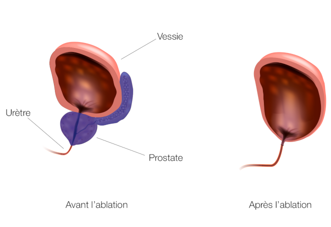 Prostate Photo Operation Votre opération par chirurgie robotique | Clinique de La Source