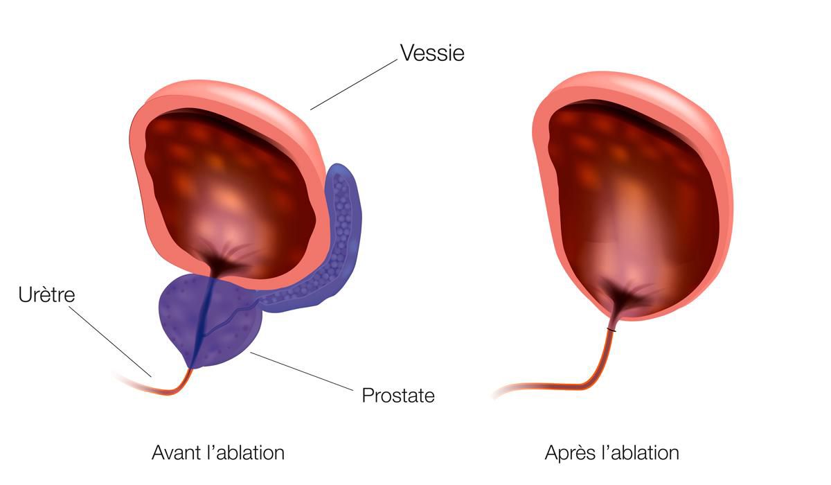 Ablation de la prostate